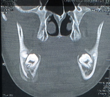 Coronal CT image
